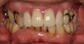 金属床義歯を、お口の中に入れた写真