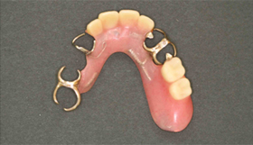 治療前：保険で作成した義歯（プラスチック）