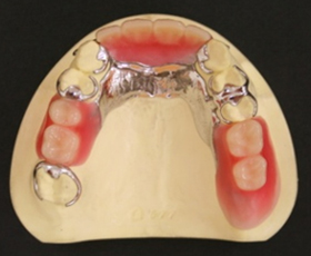 金属床義歯を、お口の中に入れた写真