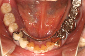 新しい義歯 の口腔内写真
